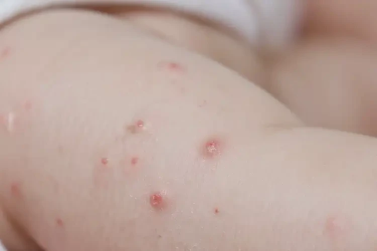 宝宝屁股上容易长湿疹能治好吗(图4)