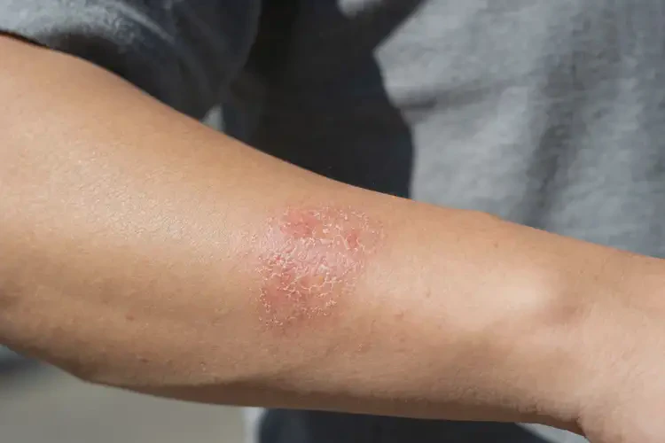 男人手臂上容易起湿疹可以治好吗(图3)