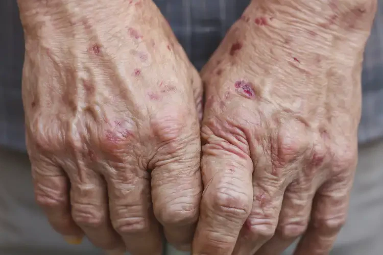 高龄老人手上有湿疹可以治好吗(图4)