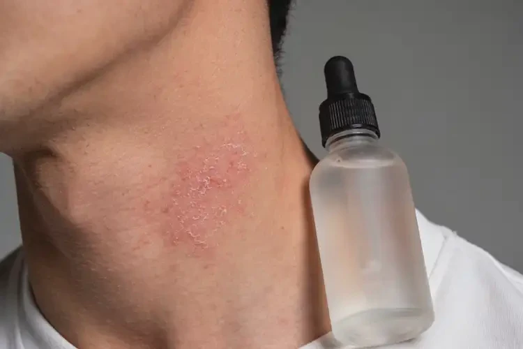 男人脖子上出现湿疹可以治好吗(图4)