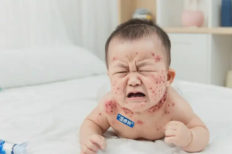 婴儿脖子出现湿疹能治好吗(图4)