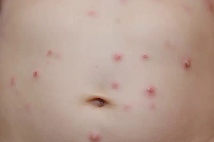 宝宝肚子长湿疹能治好吗(图4)