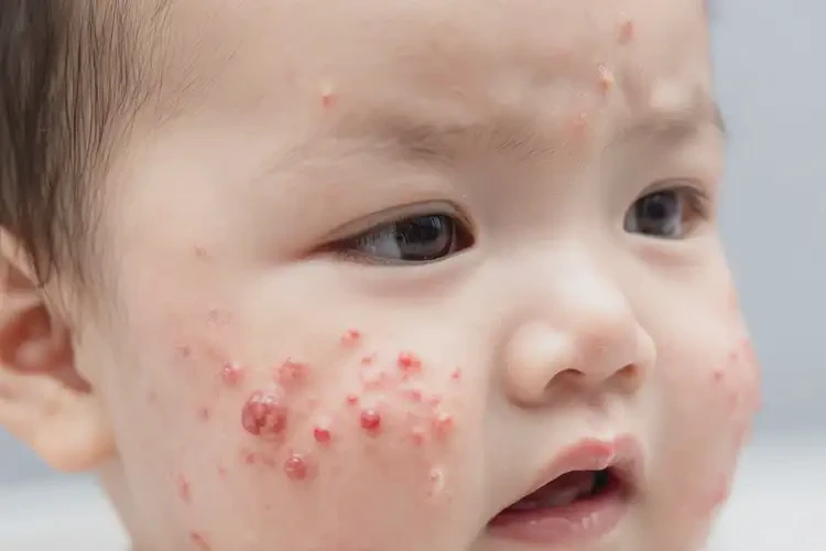 婴幼儿身上经常起湿疹能治好吗(图4)