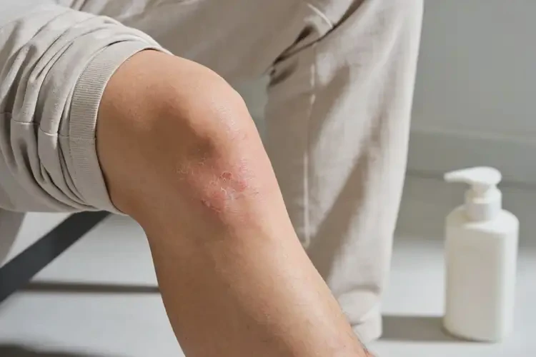 男人小腿上经常起湿疹可以治好吗(图4)