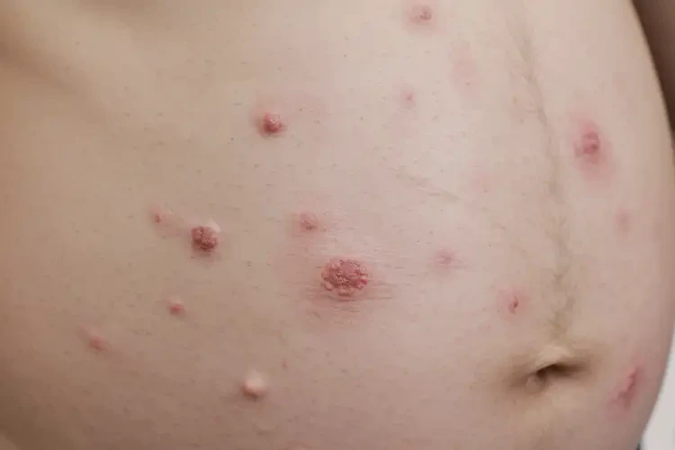 孕妇手臂偶尔长湿疹可以彻底自愈吗(图4)