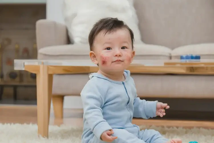 婴幼儿手上容易起湿疹能彻底自愈吗(图1)