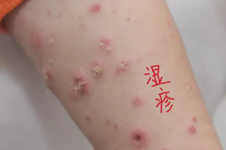 小儿全身出湿疹不管它会自己好吗(图4)
