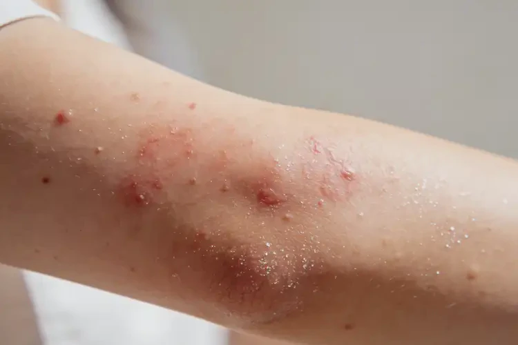 女人手臂偶尔长湿疹可以治好吗(图4)