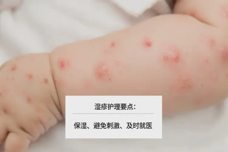 宝宝身上容易起湿疹能治好吗(图4)