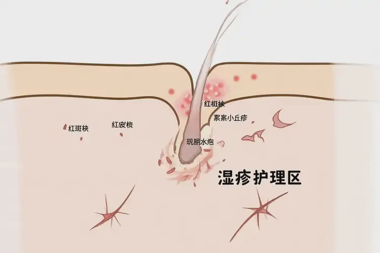 男人肛周经常起湿疹可以治好吗(图4)