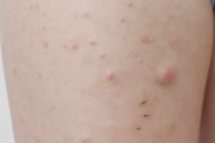 孩子大腿偶尔起湿疹不管它会自己好吗(图4)