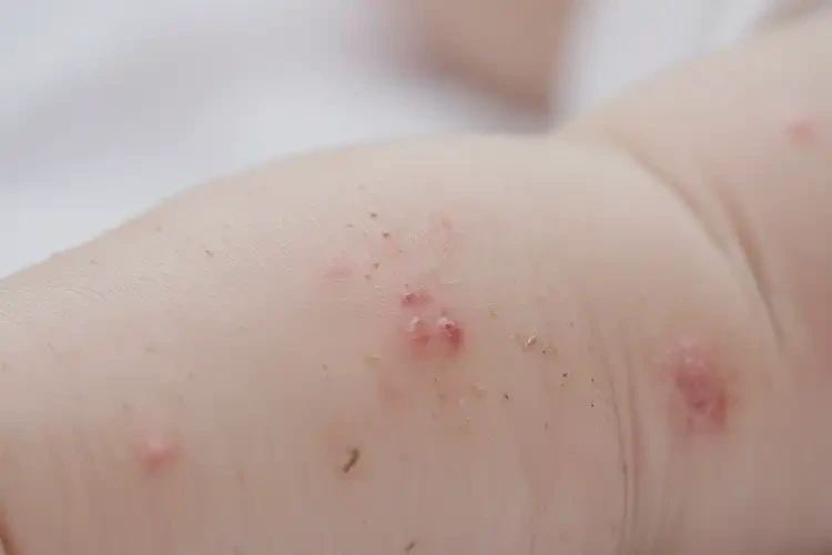 宝宝手臂上长湿疹能治好吗(图4)