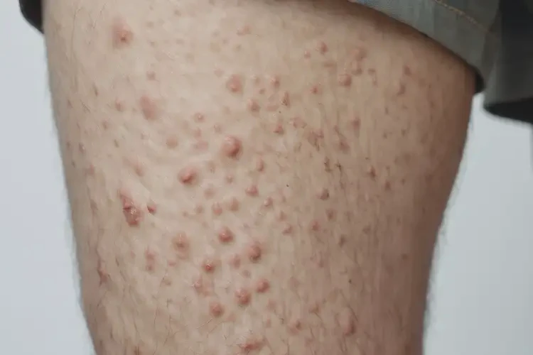 男人大腿上起湿疹可以治好吗(图4)