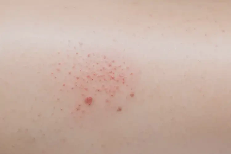 女人大腿上偶尔起湿疹可以治好吗(图3)