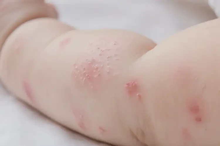 婴儿手臂偶尔起湿疹能治好吗(图3)