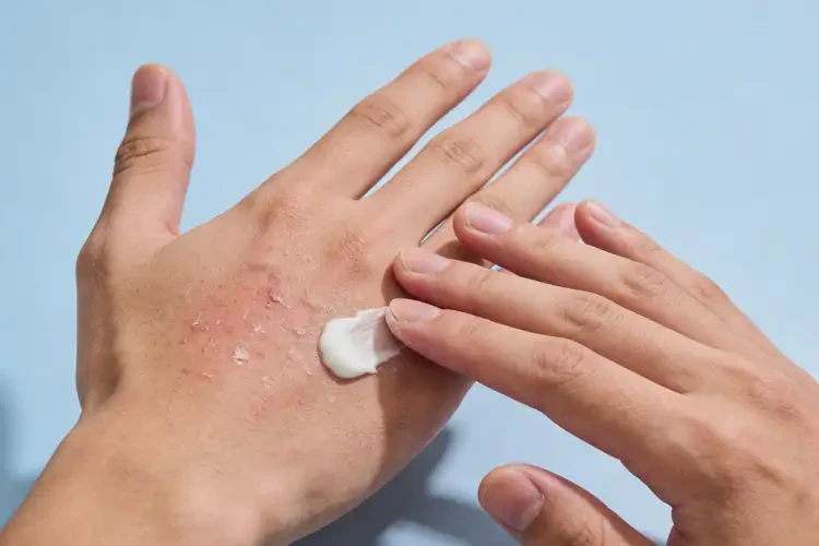 男人手上长湿疹可以治好吗(图1)