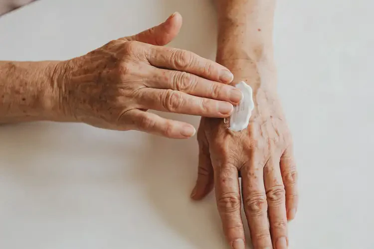 老年人手上出现湿疹不管它会自己痊愈吗(图4)