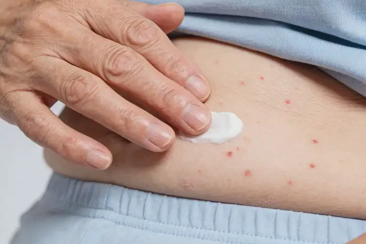 老年人肚子偶尔起湿疹可以治好吗(图3)