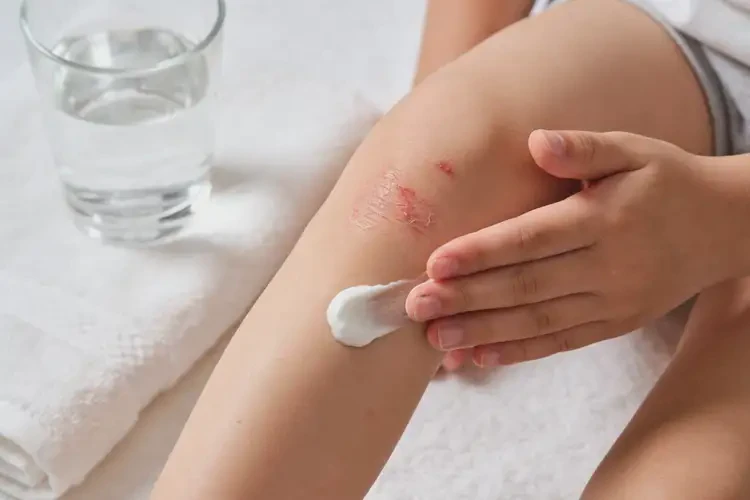 儿童小腿上偶尔起湿疹能靠自己自愈吗(图3)