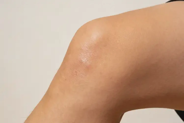 男人大腿上容易起湿疹可以治好吗(图3)