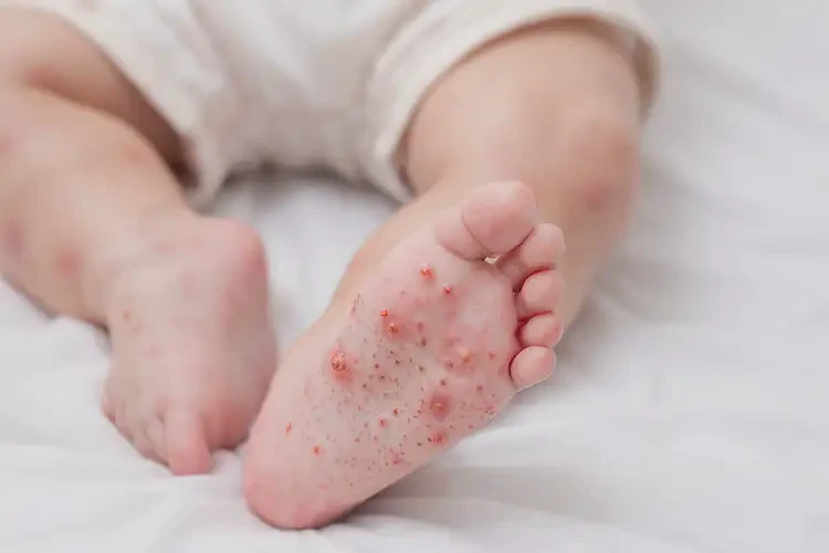 宝宝小腿经常长湿疹能治好吗(图4)