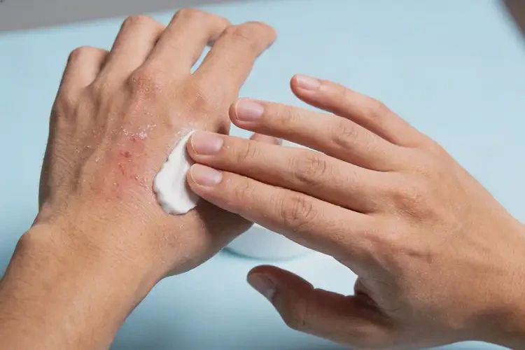 男人手上长湿疹可以治好吗(图4)