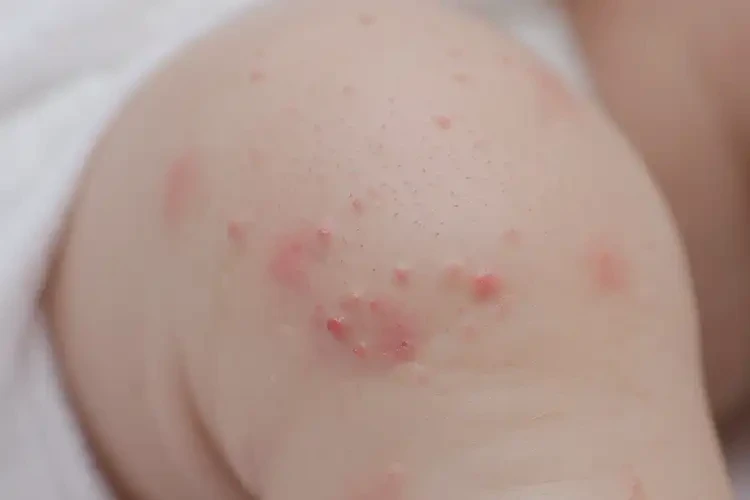 宝宝小腿上经常长湿疹能治好吗(图4)