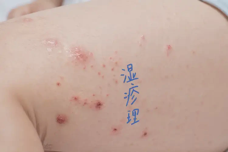 少儿大腿上经常长湿疹能治好吗(图4)