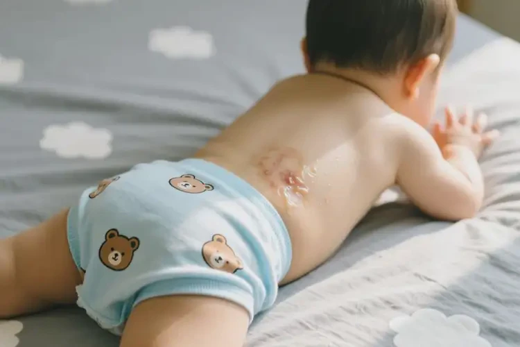 孩子屁股上出湿疹能治好吗(图3)