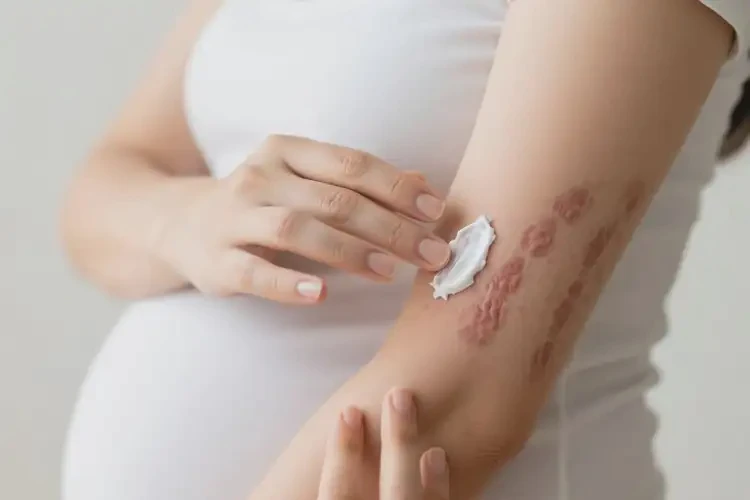 孕妇手臂上有湿疹能治好吗(图2)