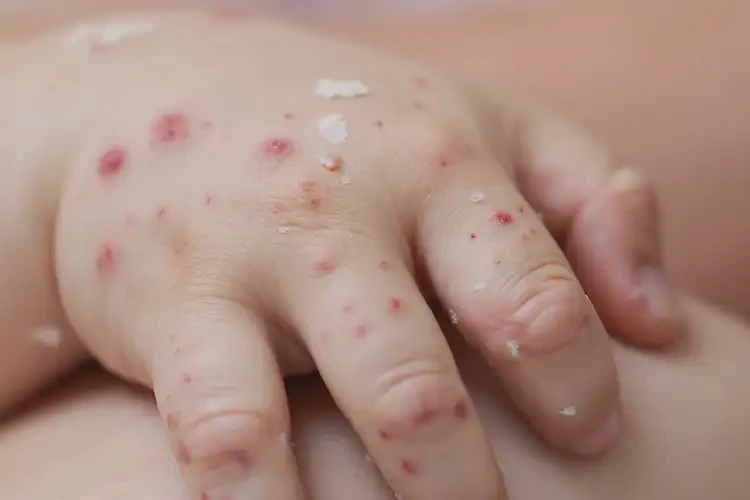 儿童手上长湿疹不管它会自己好吗(图4)