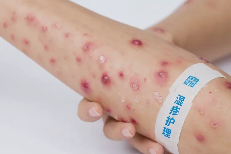 女性手臂经常起湿疹能治好吗(图4)