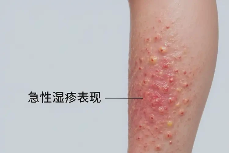 孕妇小腿上经常长湿疹能治好吗(图1)