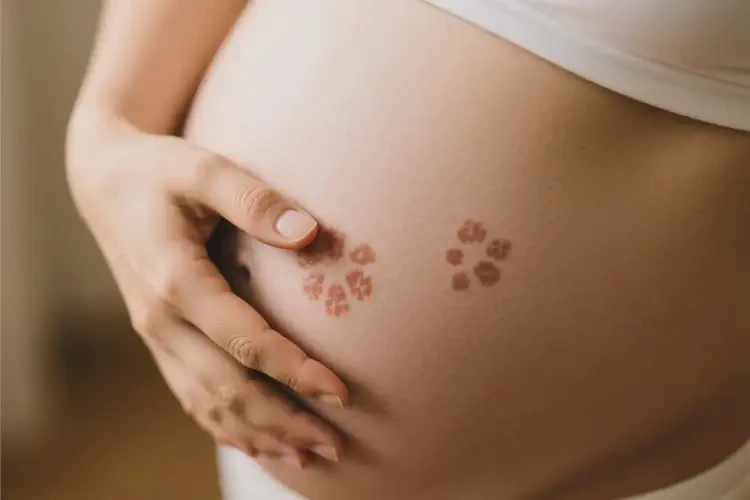 产妇肚子偶尔起湿疹能治好吗(图3)