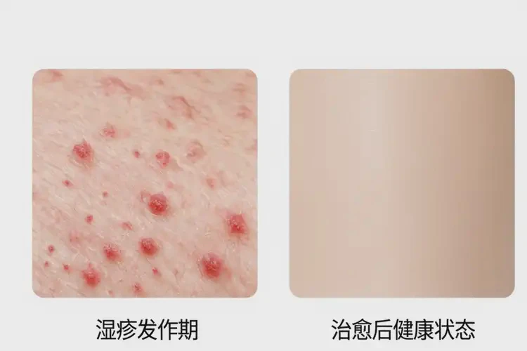 男生大腿上有湿疹能够彻底治愈吗(图1)