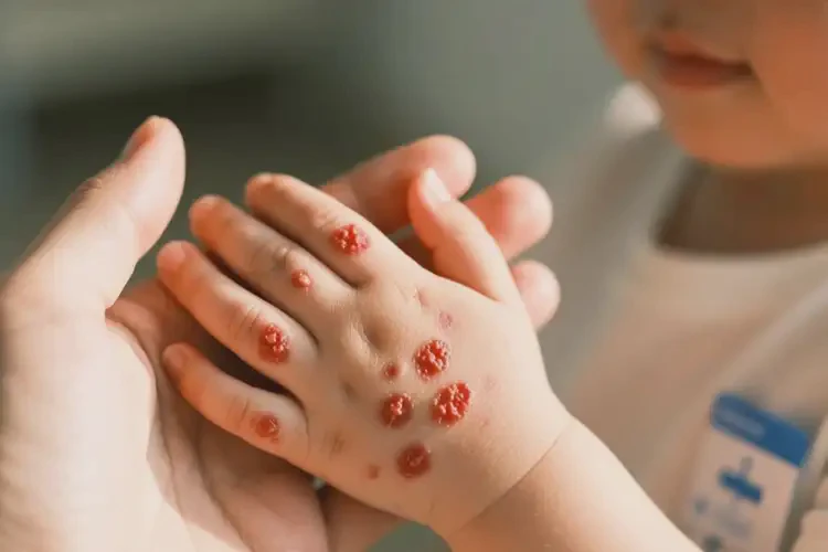 小孩手上有湿疹能治好吗(图4)