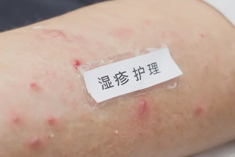 女生屁股起湿疹不管它会自己痊愈吗(图4)