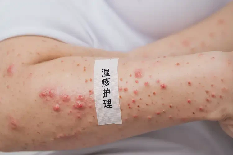 产妇手臂上有湿疹能治好吗(图4)