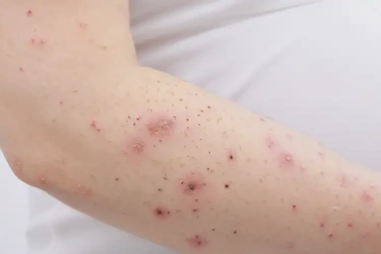 孕妇手臂上容易长湿疹能治好吗(图4)