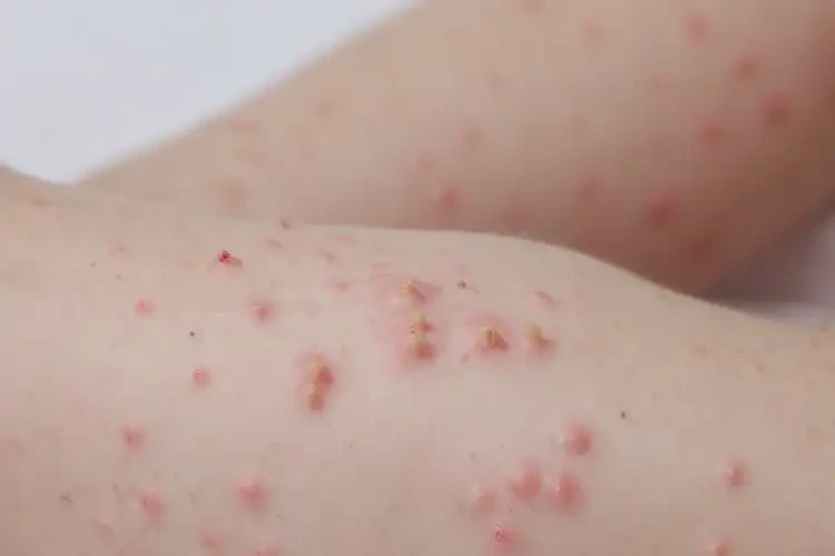 少儿四肢偶尔起湿疹能治好吗(图4)