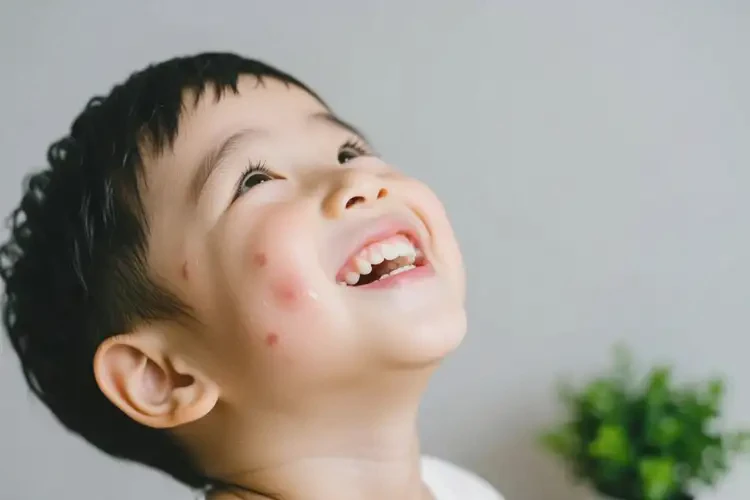 孩子面部长湿疹能治好吗(图3)