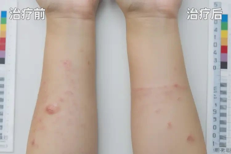 小孩手臂长湿疹能治好吗(图4)