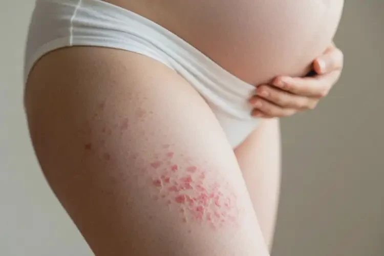 孕妇大腿偶尔长湿疹能治好吗(图1)