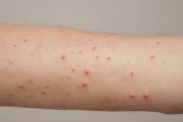 女人手臂上长湿疹可不可以彻底自愈(图2)