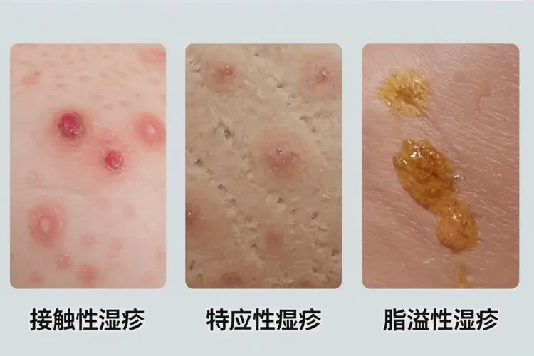 老人屁股起湿疹能治好吗(图3)