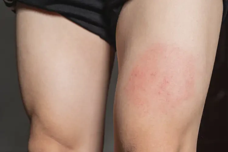 男性大腿上经常起湿疹能治好吗(图3)