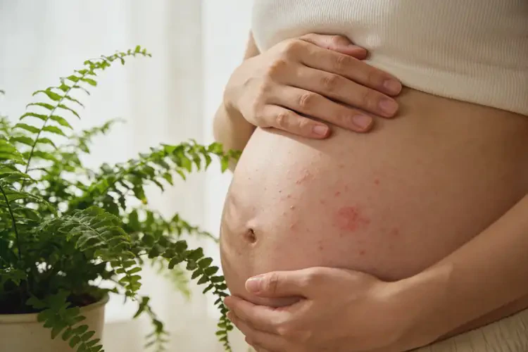 孕妇肚子长湿疹能治好吗(图2)