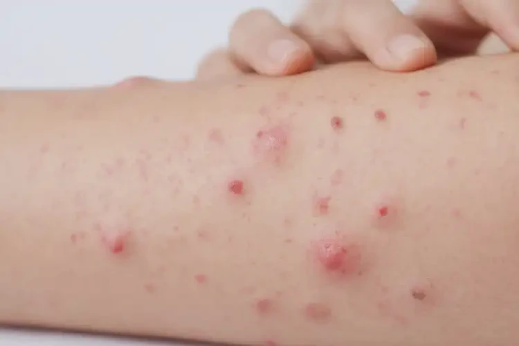 产妇手臂上偶尔长湿疹能治好吗(图4)