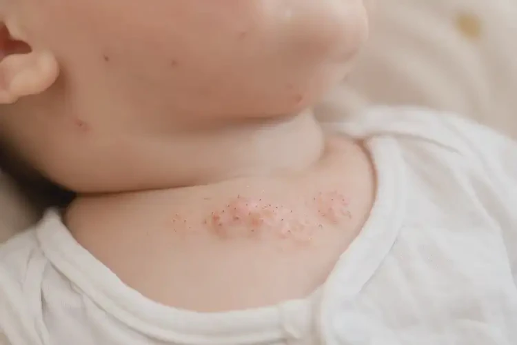 婴幼儿脖子上偶尔起湿疹可不可以彻底自愈(图4)