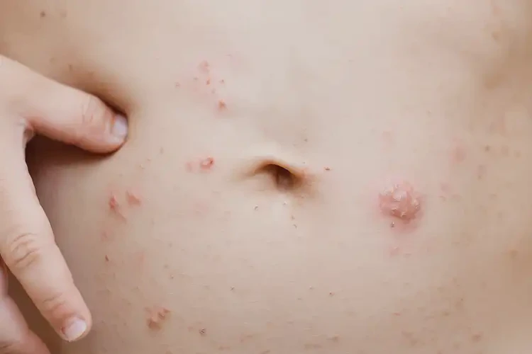 孩子肚子经常长湿疹能治好吗(图4)